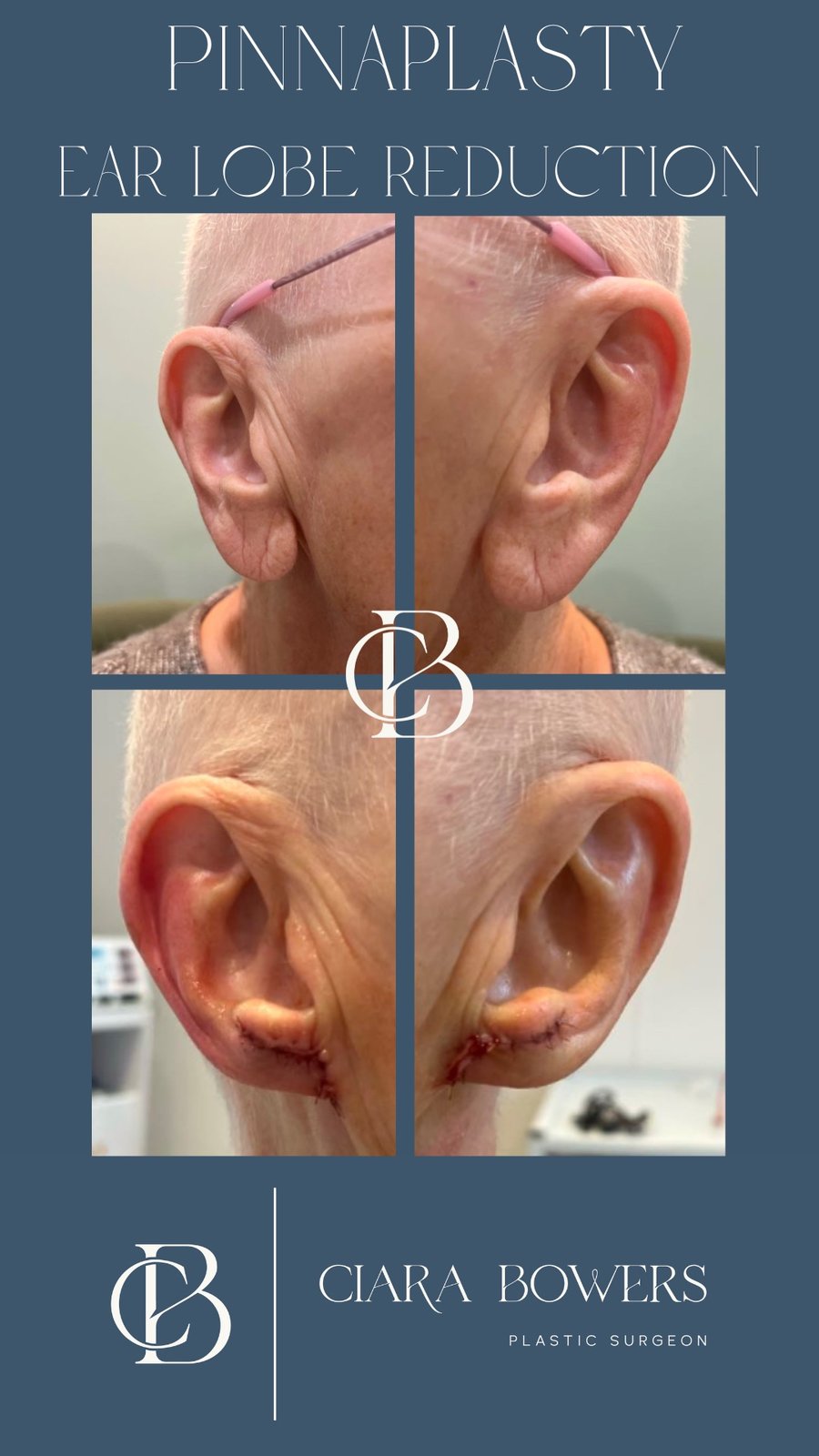 Upper-lid blepharoplasty 1 — before and after, shown with patient consent