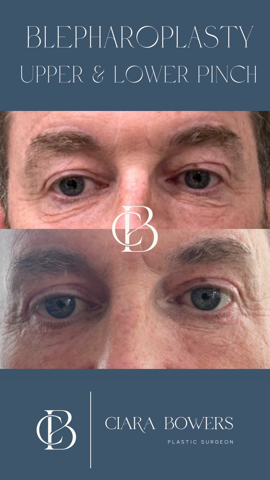 Upper-lid blepharoplasty 2 — before and after, shown with patient consent