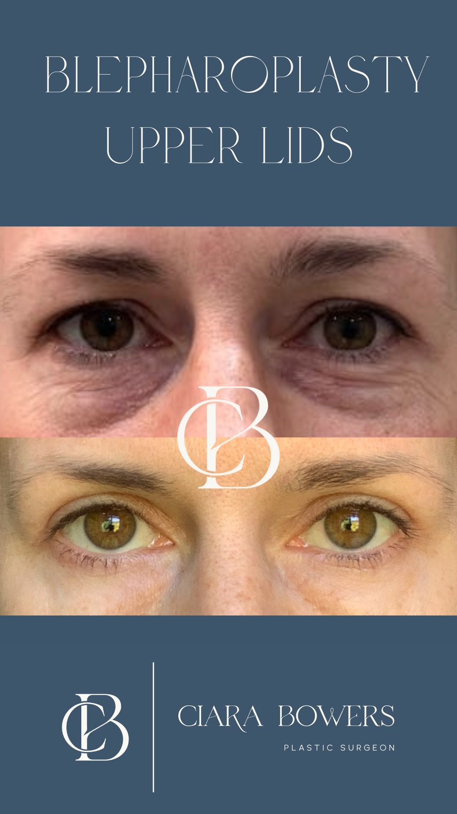 Upper-lid blepharoplasty 3 — before and after, shown with patient consent