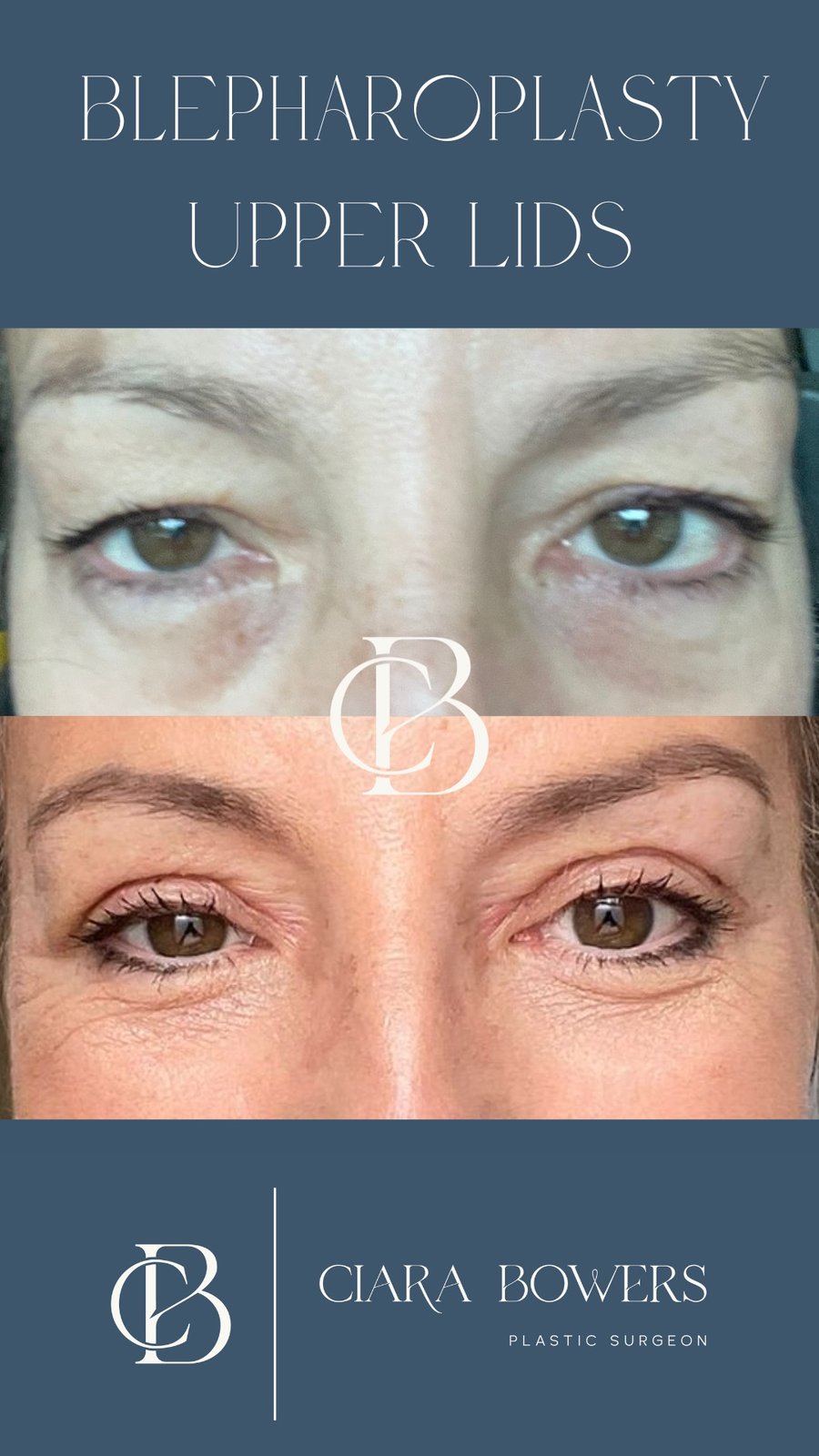 Upper-lid blepharoplasty 4 — before and after, shown with patient consent