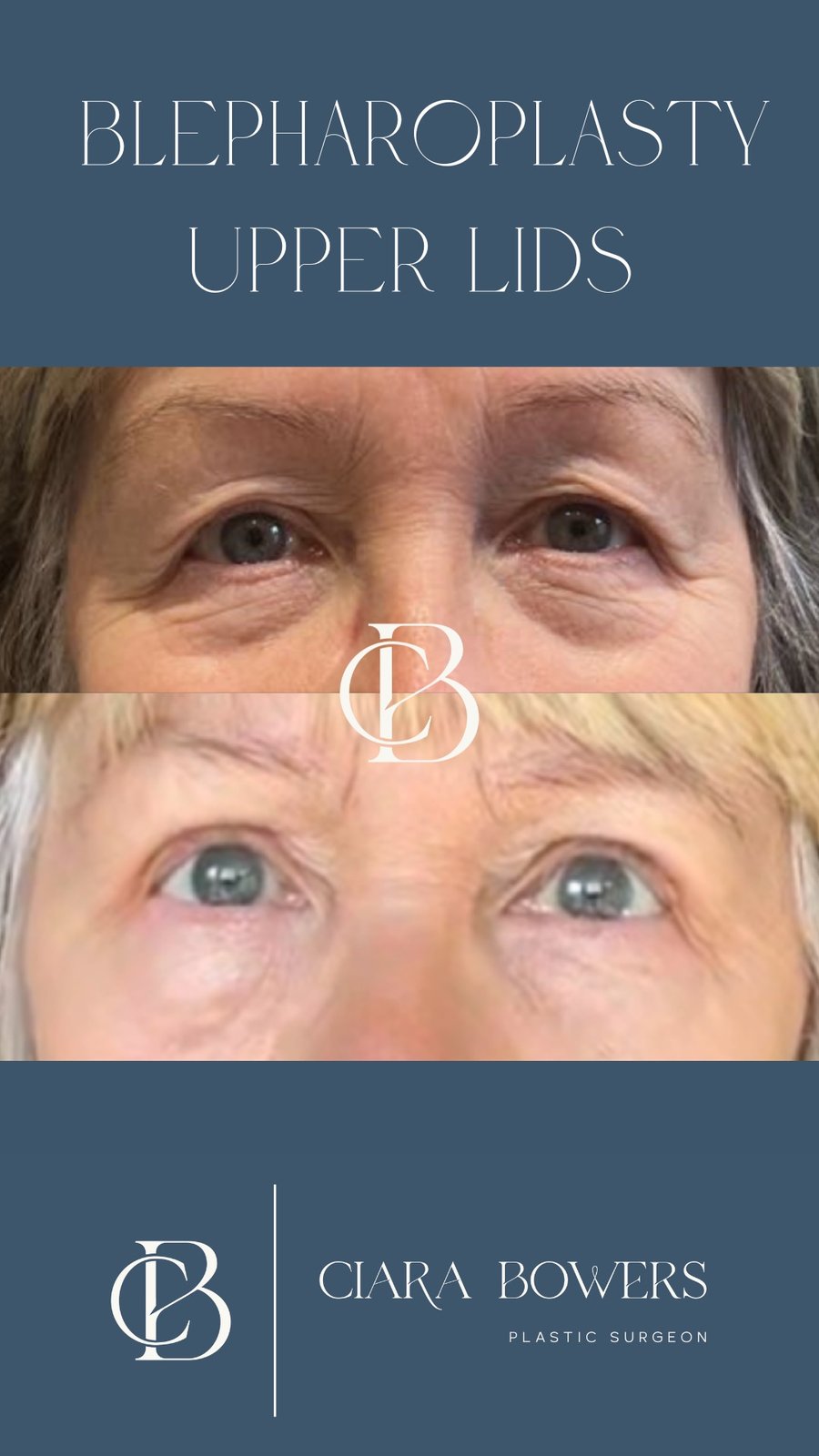 Upper-lid blepharoplasty 5 — before and after, shown with patient consent