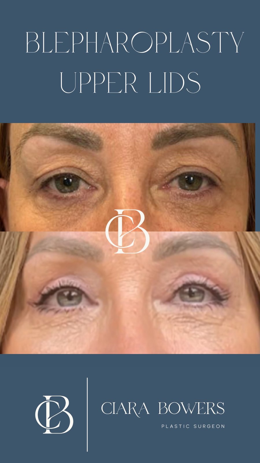 Upper-lid blepharoplasty 6 — before and after, shown with patient consent