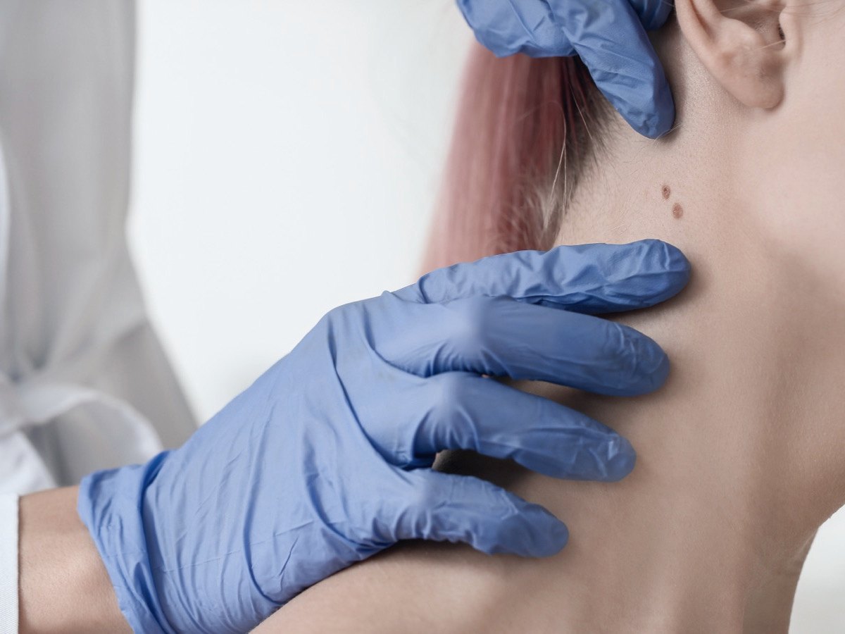 Skin cancer management