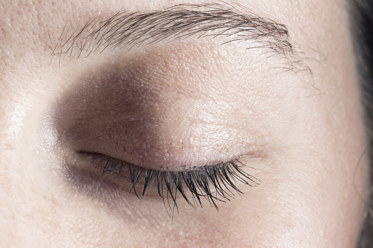Upper blepharoplasty