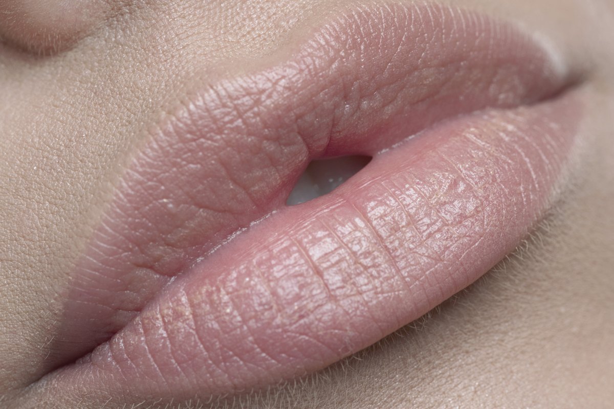 Lip lift surgery