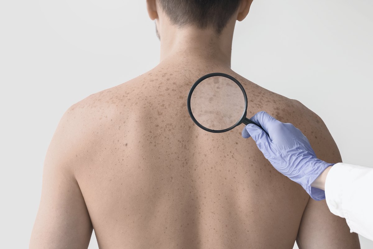 Squamous cell carcinoma (SCC)
